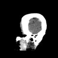 Cerebral hemorrhagic contusions (Radiopaedia 23145-23188 C 5).jpg