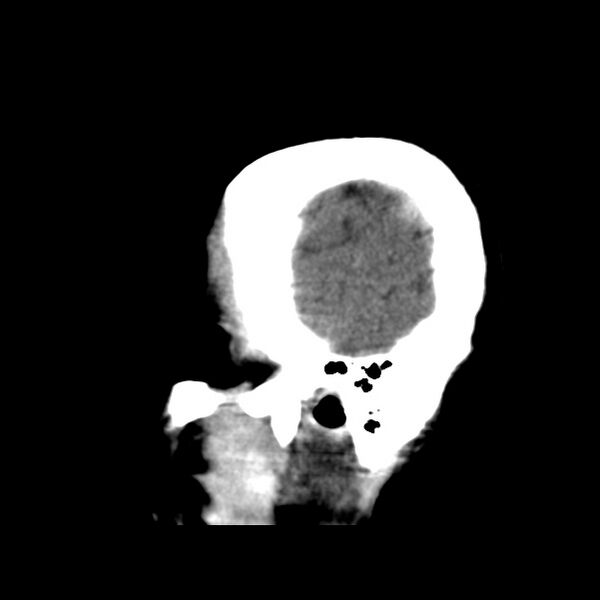 File:Cerebral hemorrhagic contusions (Radiopaedia 23145-23188 C 5).jpg