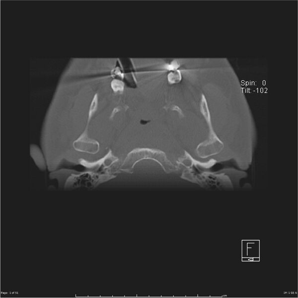 File:Cerebral hemorrhagic contusions and cervical spine fractures (Radiopaedia 32865-33841 C 1).jpg