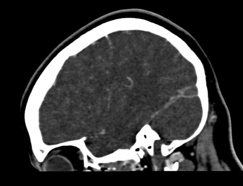 File:Cerebral venous sinus thrombosis (Radiopaedia 59224-66646 Sagittal C+ delayed 49).jpg