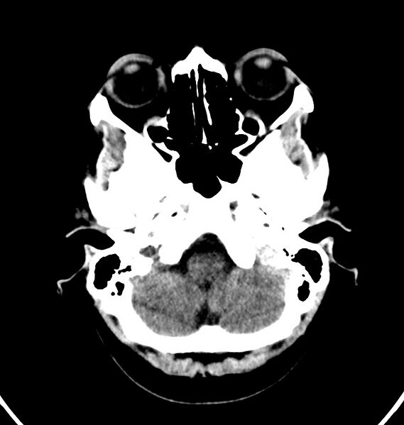 File:Cerebral venous thrombosis - CT only (Radiopaedia 41031-43778 Axial non-contrast 74).jpg