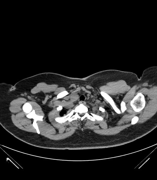 File:Cervical aortic arch with coarctation and aneurysms (Radiopaedia 44035-47552 Axial non-contrast 9).jpg