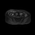 Cervical carcinoma (Radiopaedia 78847-91705 Axial T1 fat sat 2).jpg
