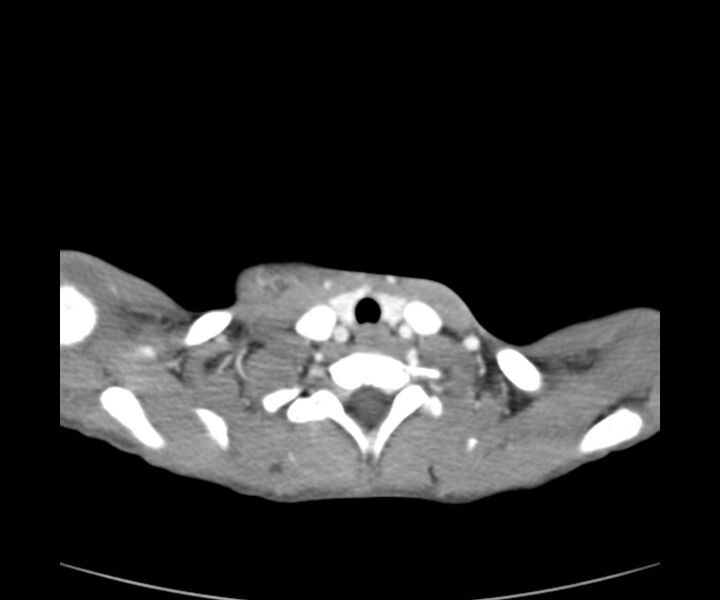 File:Cervical cystic lymphangioma (Radiopaedia 63655-72332 Axial + contrast 23).jpg