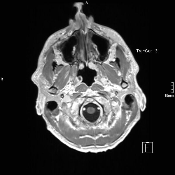 File:Cervical dural CSF leak on MRI and CT treated by blood patch (Radiopaedia 49748-54995 Axial T1 C+ 12).jpg