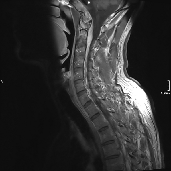 File:Cervical dural CSF leak on MRI and CT treated by blood patch (Radiopaedia 49748-54995 Sagittal T1 C+ 7).png