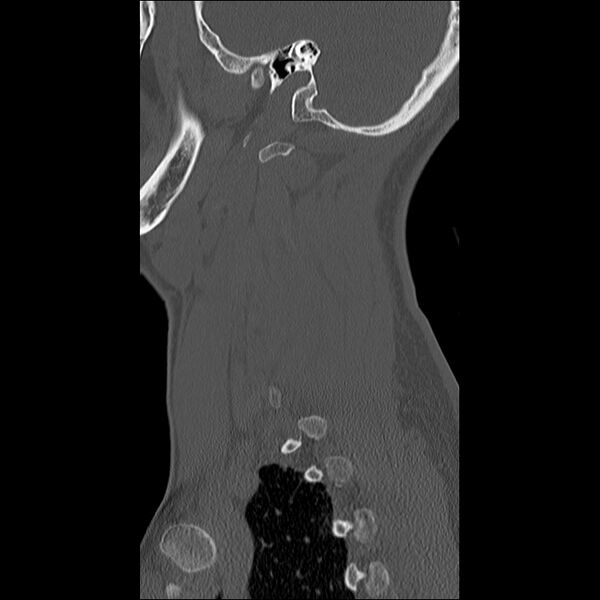 File:Cervical facet fracture and anterior discoligamentous injury (Radiopaedia 32139-33083 Sagittal bone window 2).jpg