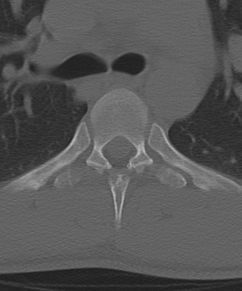 File:Cervical intercalary bone (Radiopaedia 35211-36748 Axial bone window 86).png