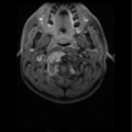 Cervical vertebrae metastasis (Radiopaedia 78814-91667 Axial T1 C+ fat sat 12).png
