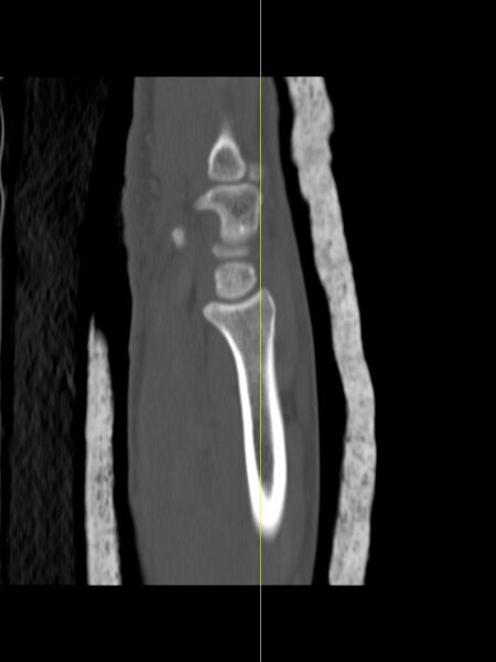 File:Chauffeur's (Hutchinson) fracture (Radiopaedia 58043-65079 Sagittal bone window 4).jpg
