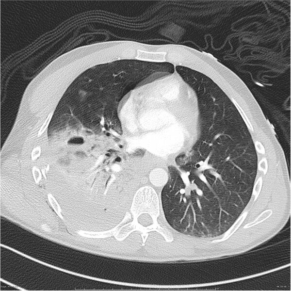 File:Chest and abdomen multi-trauma (Radiopaedia 26294-26425 lung window 63).jpg