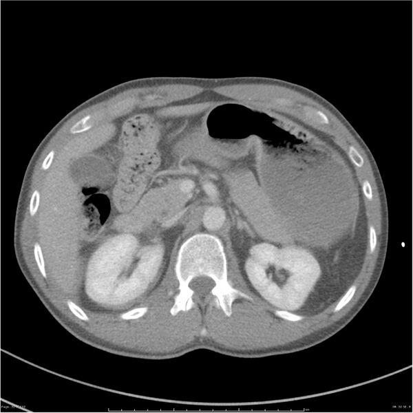 File:Chest and abdomen multi-trauma (Radiopaedia 26294-26426 bone window 30).jpg
