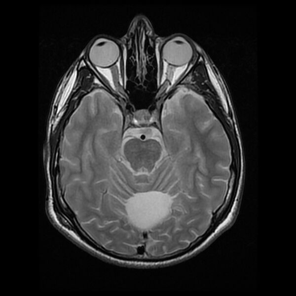 File:Chiasmatic-hypothalamic juvenile pilocytic astrocytoma (Radiopaedia 78533-91235 Axial T2 11).jpg
