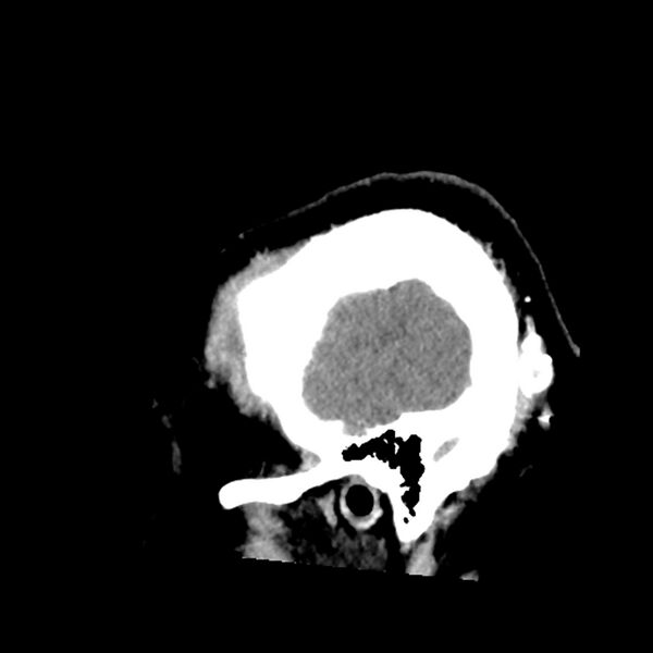 File:Chiasmatic-hypothalamic juvenile pilocytic astrocytoma (Radiopaedia 78533-91237 B 54).jpg