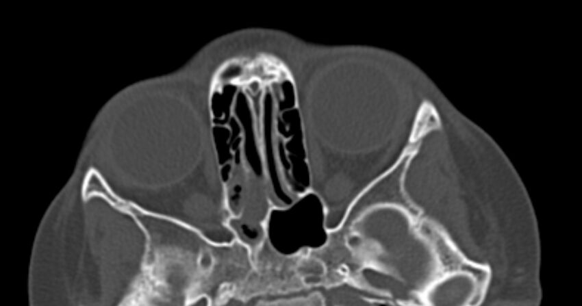 Choanal atresia (Radiopaedia 51295-56972 Axial bone window 42).jpg