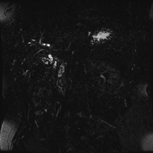 File:Choledocholithiasis on CT and MRI (Radiopaedia 24825-25088 Coronal T2 25).jpg