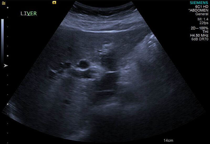 File:Cholelithiasis with biliary dilatation (Radiopaedia 49442-54588 A 2).jpg