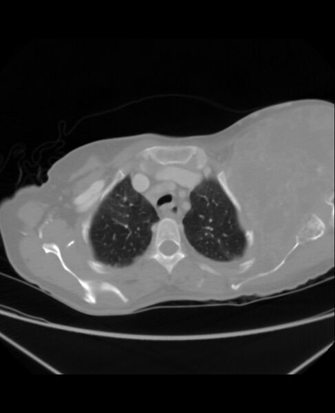 File:Chondrosarcoma (Radiopaedia 79427-92535 Axial lung window 10).jpg