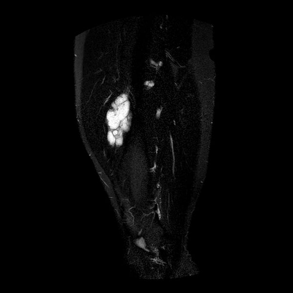 File:Chondrosarcoma arising from exostosis (Radiopaedia 59996-67686 Sagittal STIR 3).jpg