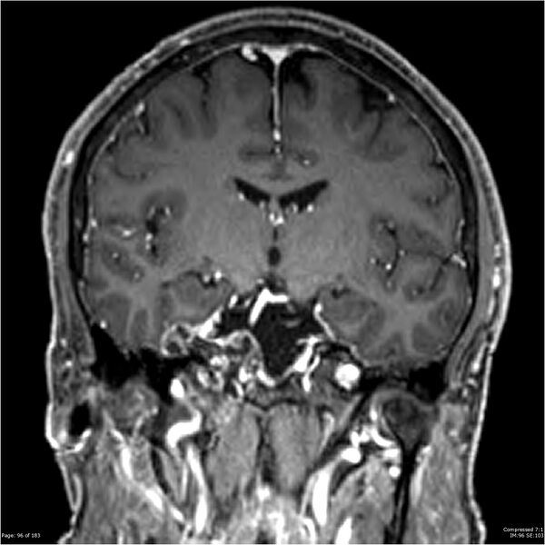 File:Chondrosarcoma of skull base- grade II (Radiopaedia 40948-43654 Coronal T1 C+ 7).jpg