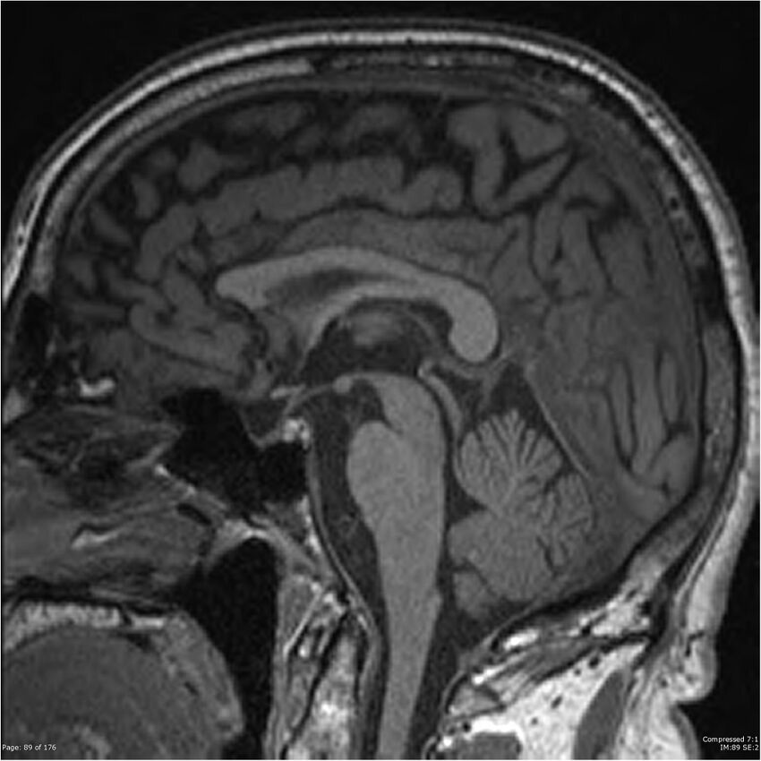 Chondrosarcoma of skull base- grade II (Radiopaedia 40948-43654 Sagittal T1 12).jpg