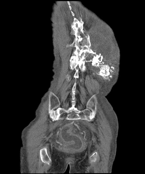 File:Chondrosarcoma of the spine (Radiopaedia 49871-55143 B 5).jpg