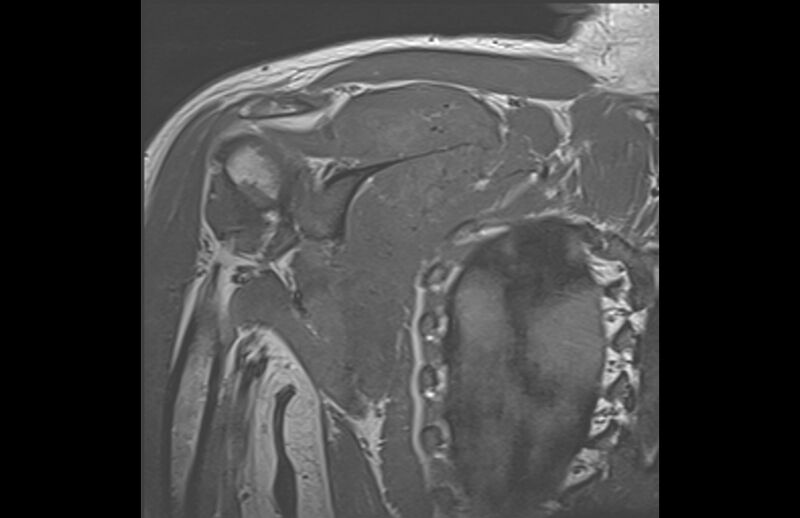 File:Choriocarcinoma in the shoulder (Radiopaedia 28603-28861 Coronal T1 10).jpg