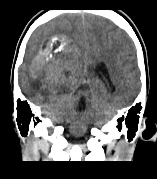 File:Choroid plexus carcinoma (Radiopaedia 91013-108552 Coronal non-contrast 56).jpg