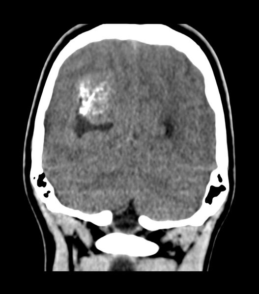 File:Choroid plexus carcinoma (Radiopaedia 91013-108552 Coronal non-contrast 68).jpg
