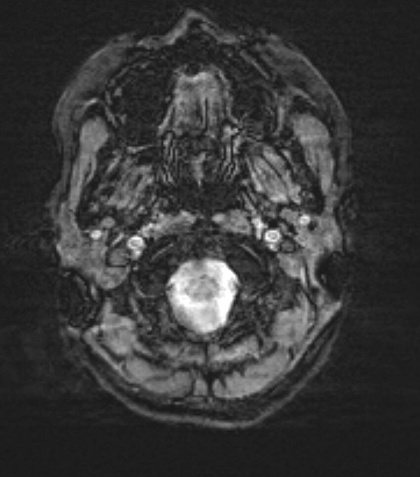 Choroid plexus carcinoma (Radiopaedia 91013-108553 Axial SWI 5).jpg
