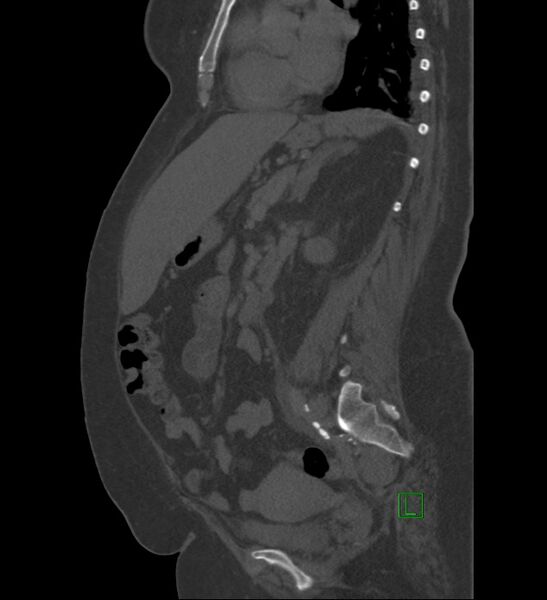 File:Chromophobe renal cell carcinoma (Radiopaedia 84239-99519 Sagittal bone window 45).jpg