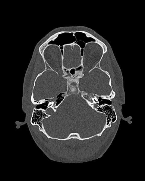 File:Chronic maxillary sinusitis caused by a foreign body (Radiopaedia 58521-65676 Axial bone window 240).jpg