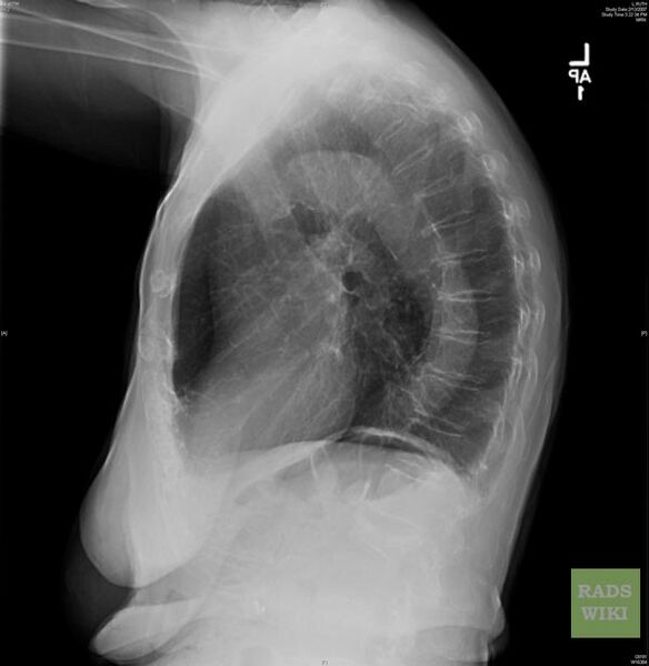 File:Chronic obstructive pulmonary disease (Radiopaedia 11311-11675 Lateral 1).jpg
