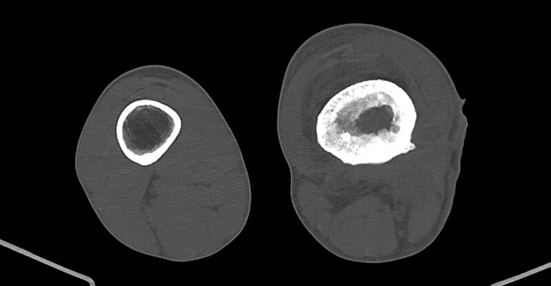 File:Chronic osteomyelitis (with sequestrum) (Radiopaedia 74813-85822 Axial non-contrast 154).jpg