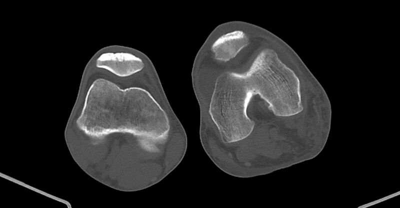 File:Chronic osteomyelitis (with sequestrum) (Radiopaedia 74813-85822 Axial non-contrast 183).jpg