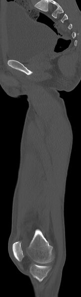 File:Chronic osteomyelitis (with sequestrum) (Radiopaedia 74813-85822 C 62).jpg
