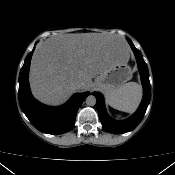 File:Chronic pancreatitis (Radiopaedia 23132-23172 Axial non-contrast 13).jpg