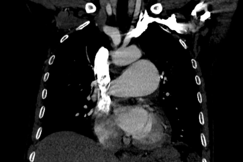 Chronic pulmonary embolism with bubbly consolidation (Radiopaedia 91248-108850 B 64).jpg
