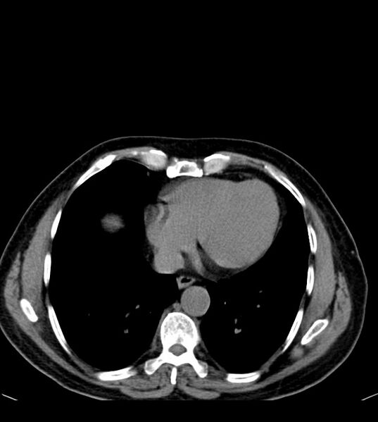 File:Clear cell renal cell carcinoma (Radiopaedia 85006-100539 Axial non-contrast 9).jpg