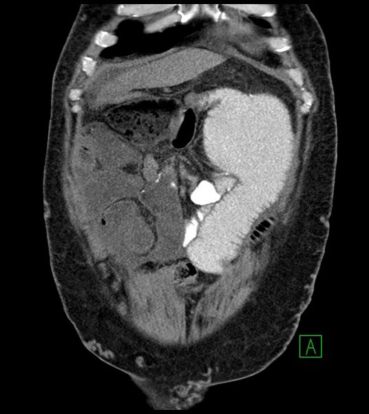 File:Closed-loop small bowel obstruction-internal hernia (Radiopaedia 78439-91096 Coronal non-contrast 26).jpg