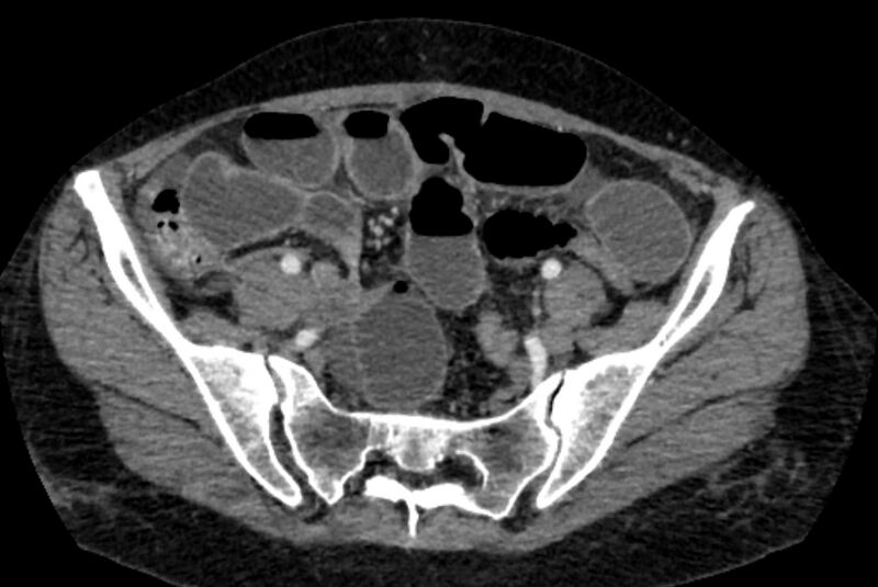 File:Closed loop small bowel obstruction (Radiopaedia 71211-81508 A 117).jpg