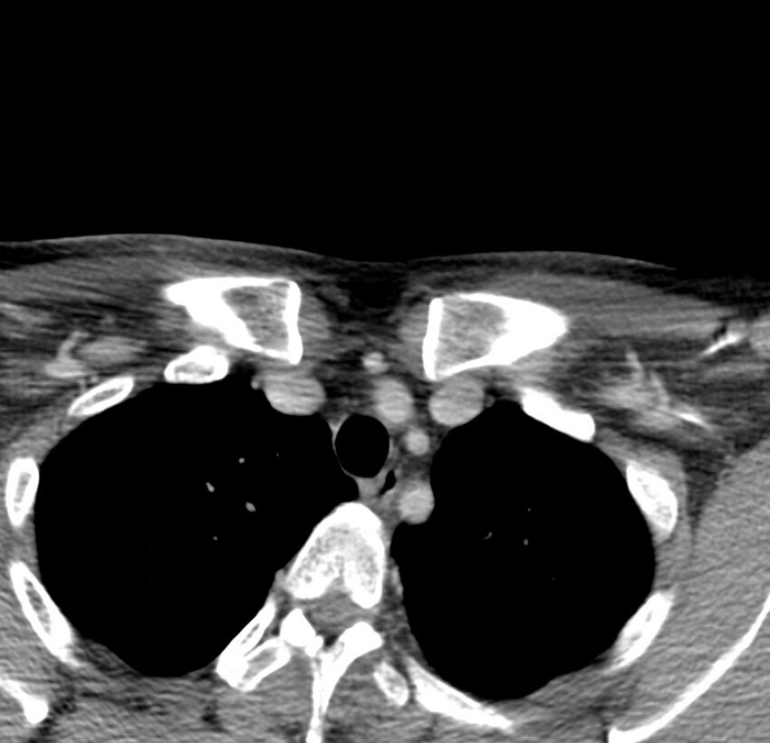 Colloid cyst of thyroid (Radiopaedia 22897-22923 Axial C+ delayed 78).jpg