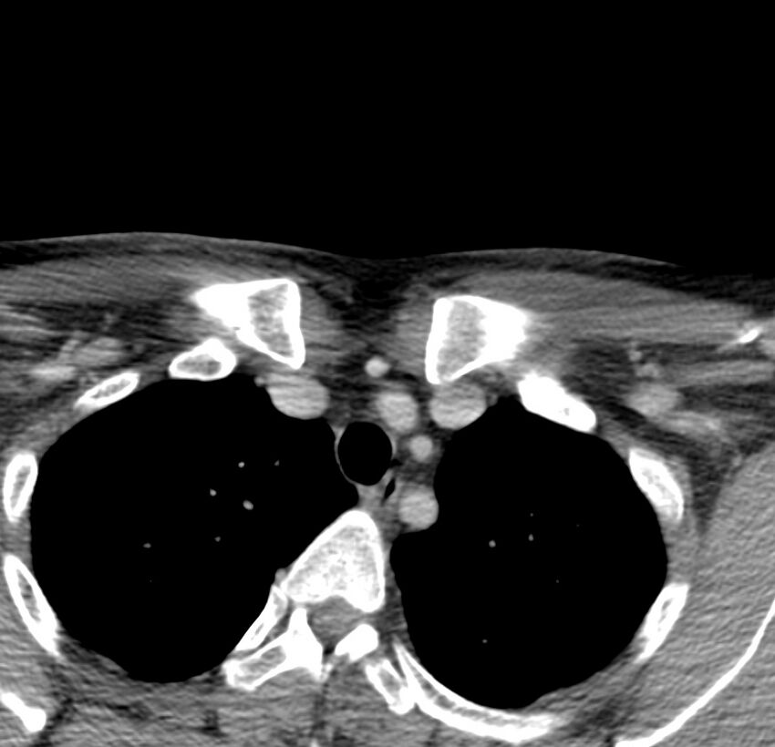 Colloid cyst of thyroid (Radiopaedia 22897-22923 Axial C+ delayed 79).jpg