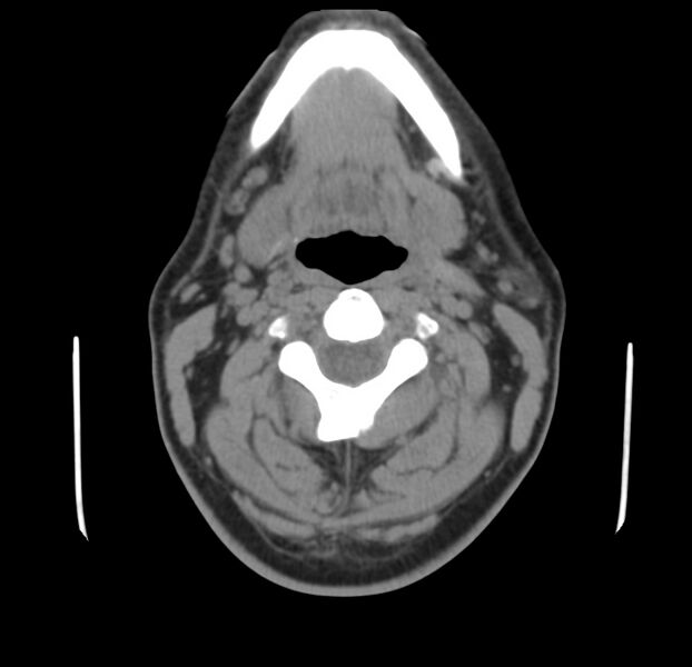 File:Colloid cyst of thyroid (Radiopaedia 22897-22923 Axial non-contrast 21).jpg