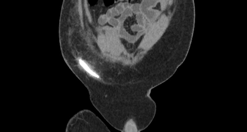 File:Colocutaneous fistula (Radiopaedia 56401-63062 C 12).jpg