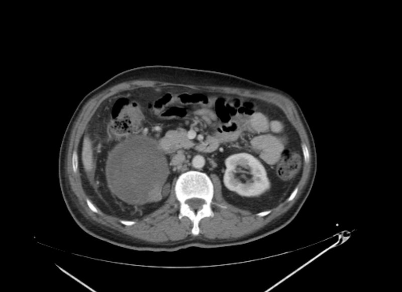File:Colon cancer mimicking renal cell carcinoma (Radiopaedia 28986-29335 C 31).jpg