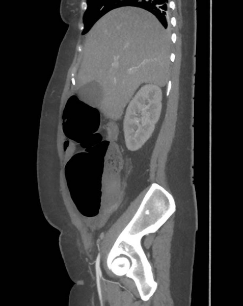File:Colonic pseudo-obstruction (Radiopaedia 79752-92980 C 25).png