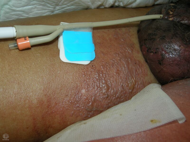 File:Fournier gangrene (DermNet NZ figure-12-fever+rash).jpg