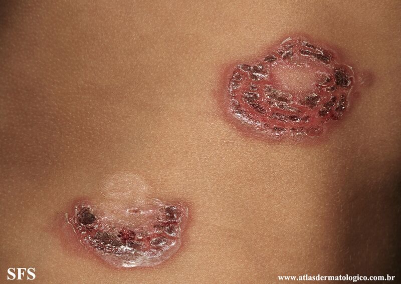 File:Impetigo (Dermatology Atlas 86).jpg