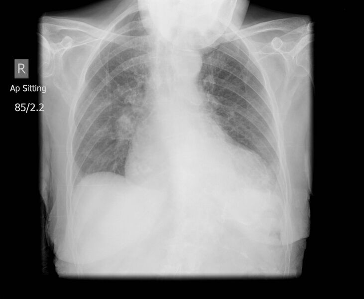 File:Left ventricular aneurysm (Radiopaedia 12852).jpg